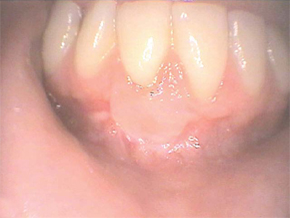 After gum recession treatments