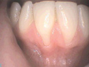 Before gum recession treatments